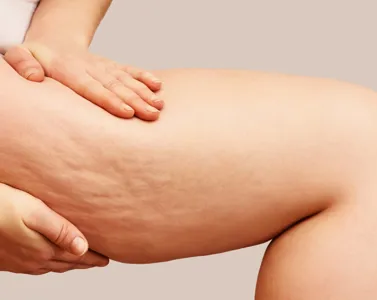 La Verità sulla Cellulite: cause, prevenzione e trattamenti efficaci